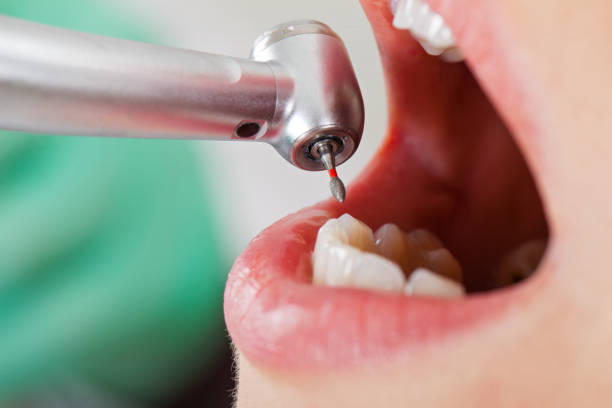 Best Emergency Tooth Extraction in Mchenry, IL